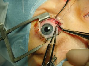 L'opération des yeux