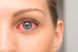 Redness on female eye, macro image